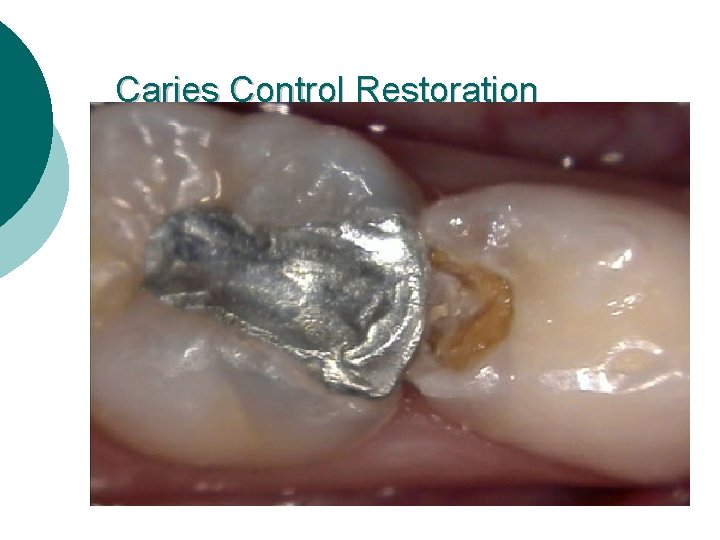 Caries Control Restoration 