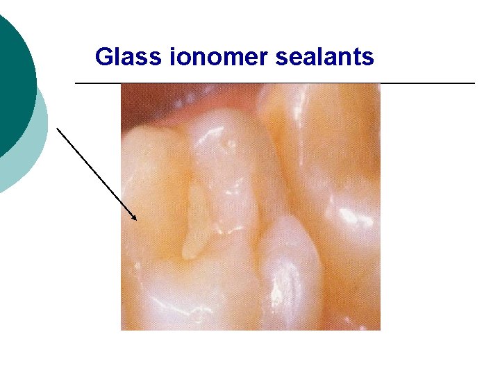 Glass ionomer sealants 