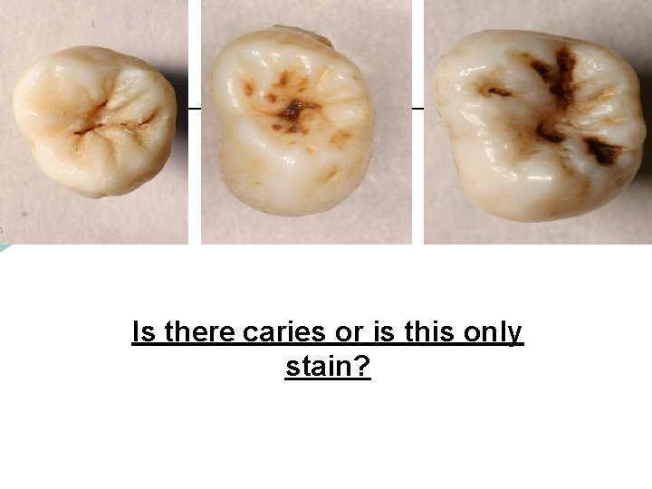 Is there caries or is this only stain? 