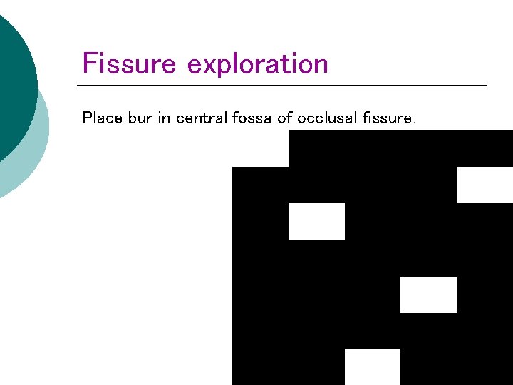 Fissure exploration Place bur in central fossa of occlusal fissure. 