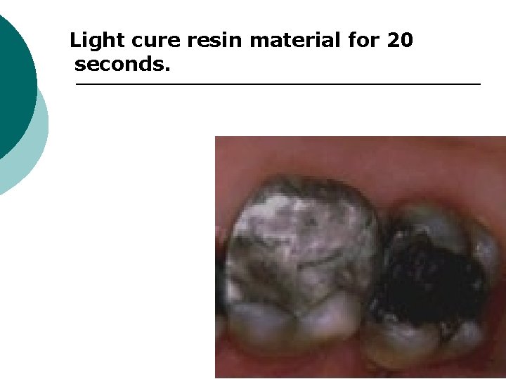  Light cure resin material for 20 seconds. 