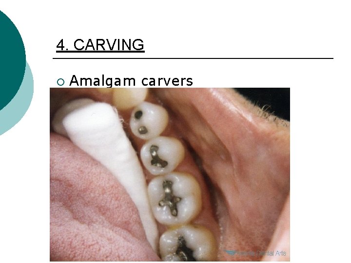 4. CARVING ¡ Amalgam carvers 