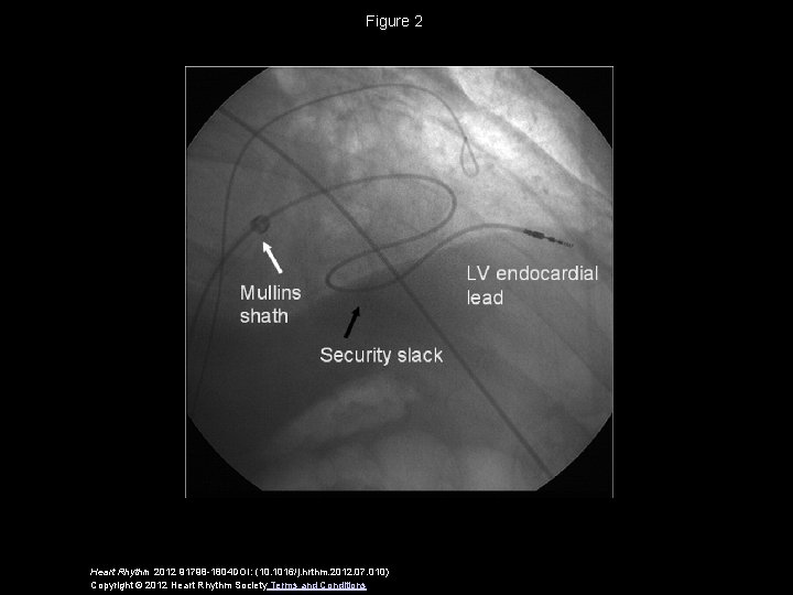 Figure 2 Heart Rhythm 2012 91798 -1804 DOI: (10. 1016/j. hrthm. 2012. 07. 010)