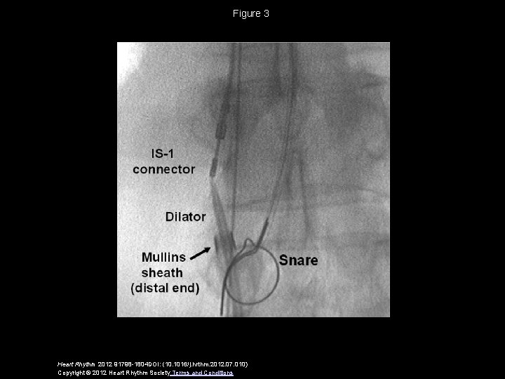 Figure 3 Heart Rhythm 2012 91798 -1804 DOI: (10. 1016/j. hrthm. 2012. 07. 010)