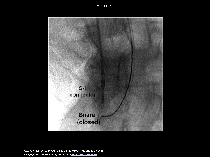 Figure 4 Heart Rhythm 2012 91798 -1804 DOI: (10. 1016/j. hrthm. 2012. 07. 010)