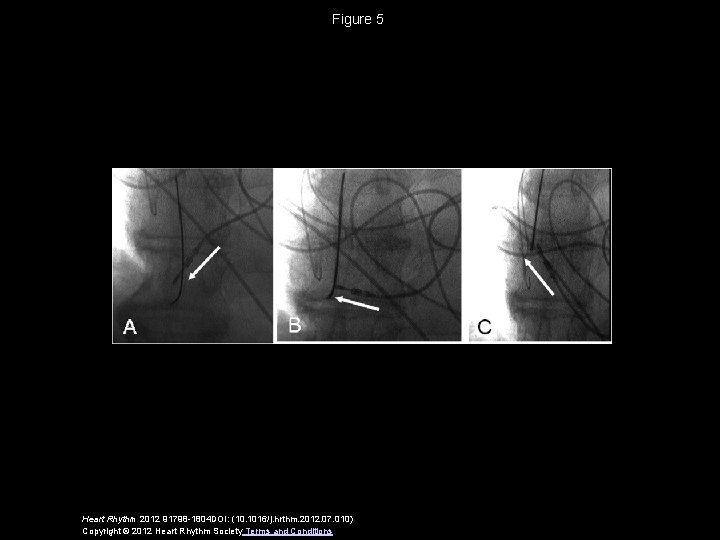 Figure 5 Heart Rhythm 2012 91798 -1804 DOI: (10. 1016/j. hrthm. 2012. 07. 010)