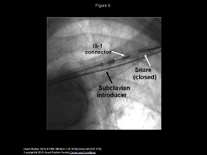 Figure 6 Heart Rhythm 2012 91798 -1804 DOI: (10. 1016/j. hrthm. 2012. 07. 010)