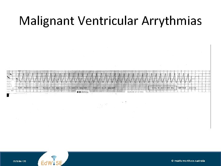 Malignant Ventricular Arrythmias October 20 © Health Workforce Australia 