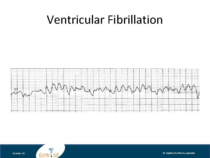 Ventricular Fibrillation October 20 © Health Workforce Australia 