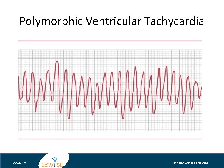 Polymorphic Ventricular Tachycardia October 20 © Health Workforce Australia 