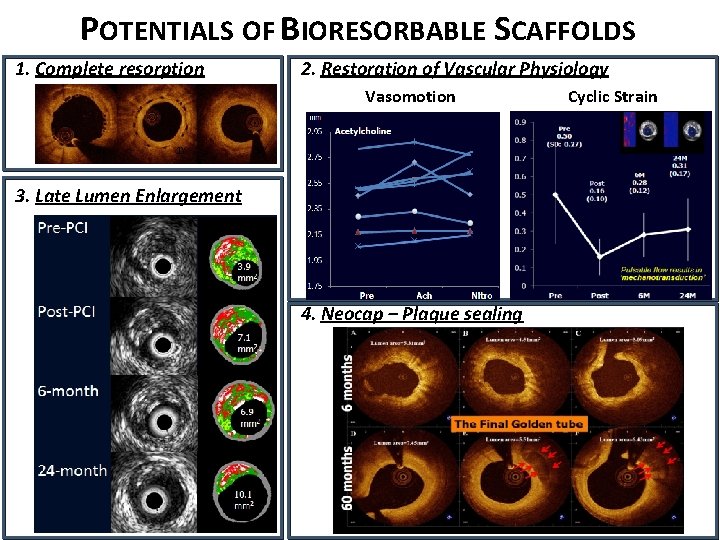 POTENTIALS OF BIORESORBABLE SCAFFOLDS 1. Complete resorption 2. Restoration of Vascular Physiology Vasomotion BL