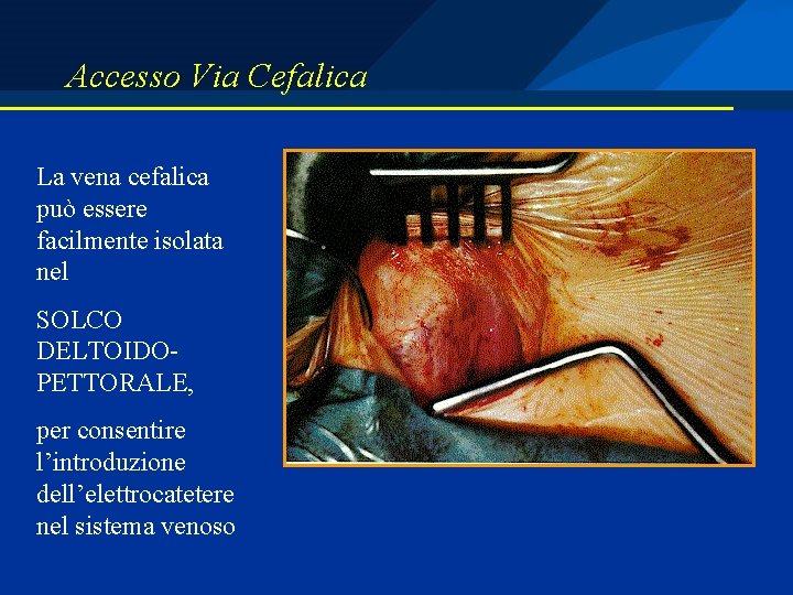 Accesso Via Cefalica La vena cefalica può essere facilmente isolata nel SOLCO DELTOIDOPETTORALE, per