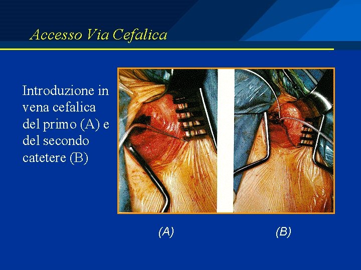 Accesso Via Cefalica Introduzione in vena cefalica del primo (A) e del secondo catetere