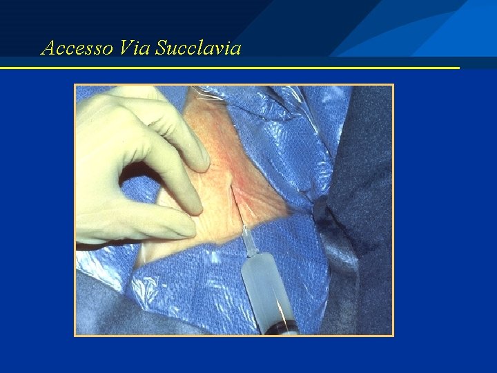 Accesso Via Succlavia 