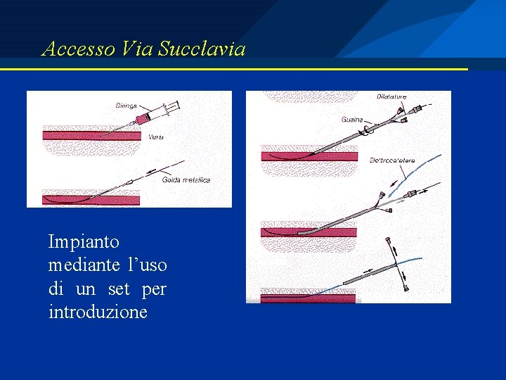 Accesso Via Succlavia Impianto mediante l’uso di un set per introduzione 