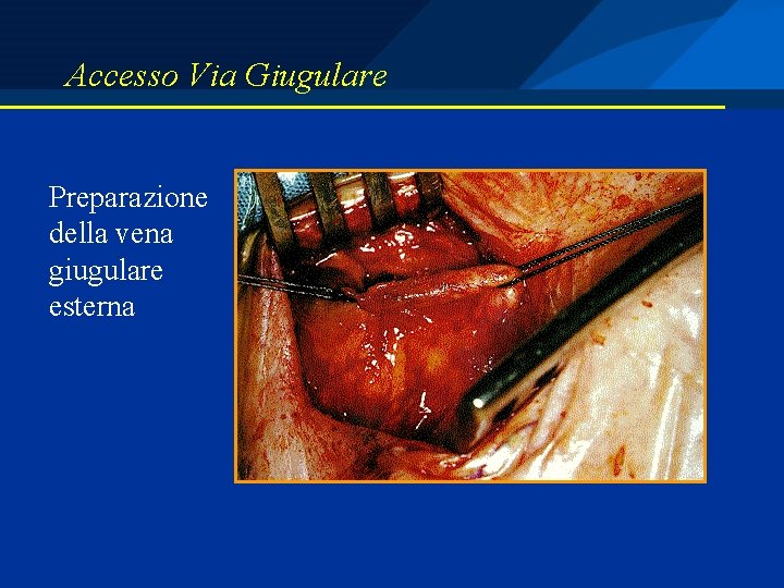 Accesso Via Giugulare Preparazione della vena giugulare esterna 