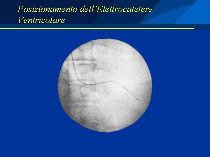 Posizionamento dell’Elettrocatetere Ventricolare 