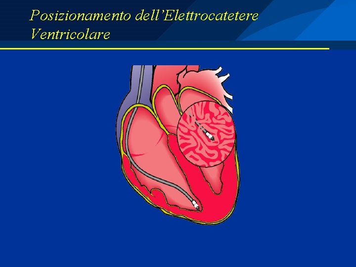 Posizionamento dell’Elettrocatetere Ventricolare 