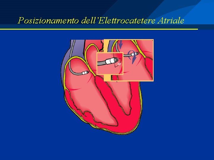 Posizionamento dell’Elettrocatetere Atriale 