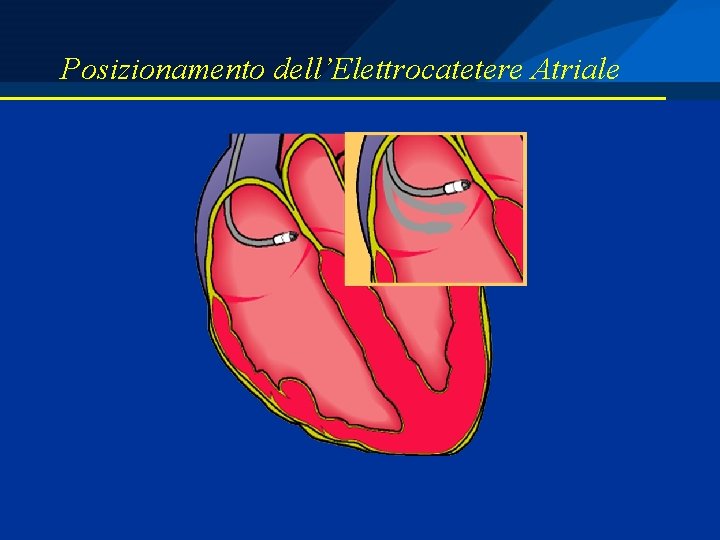 Posizionamento dell’Elettrocatetere Atriale 