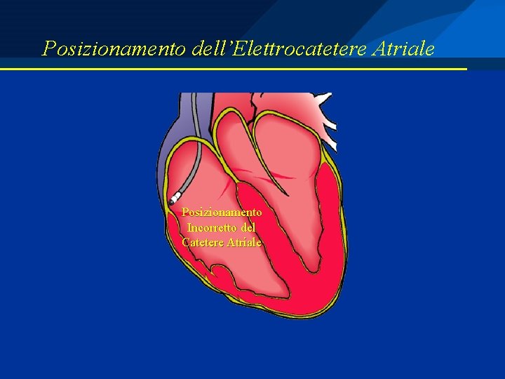 Posizionamento dell’Elettrocatetere Atriale Posizionamento Incorretto del Catetere Atriale 