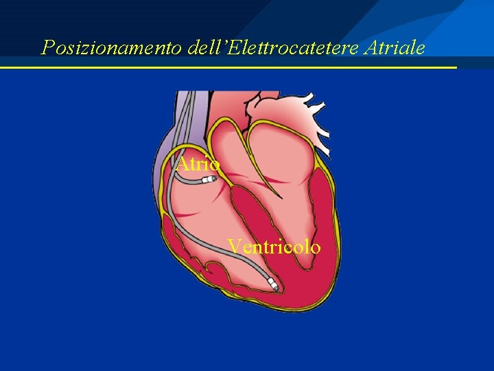 Posizionamento dell’Elettrocatetere Atriale Atrio Ventricolo 