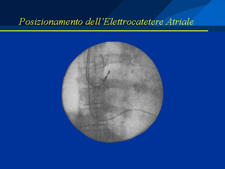 Posizionamento dell’Elettrocatetere Atriale 