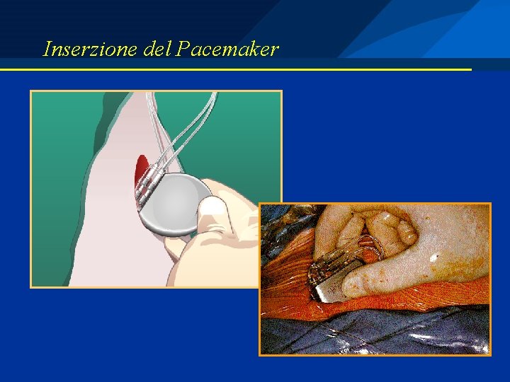 Inserzione del Pacemaker 