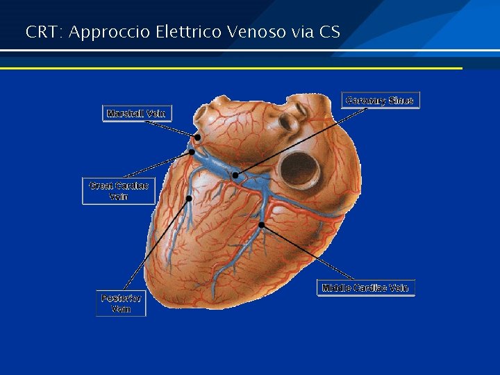 CRT: Approccio Elettrico Venoso via CS 