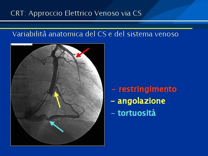 CRT: Approccio Elettrico Venoso via CS Variabilità anatomica del CS e del sistema venoso