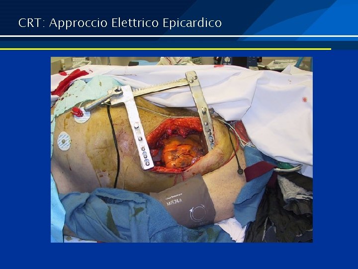 CRT: Approccio Elettrico Epicardico 