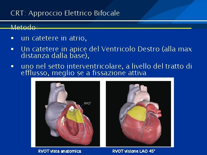 CRT: Approccio Elettrico Bifocale Metodo: § un catetere in atrio, § Un catetere in