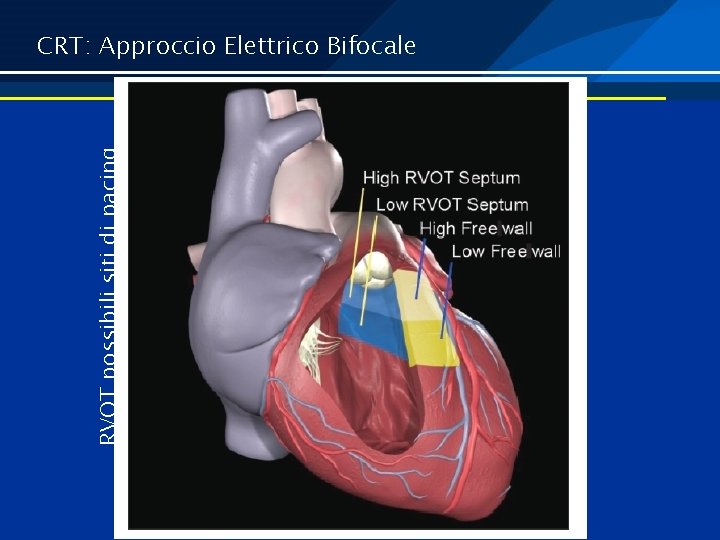 RVOT possibili siti di pacing CRT: Approccio Elettrico Bifocale 