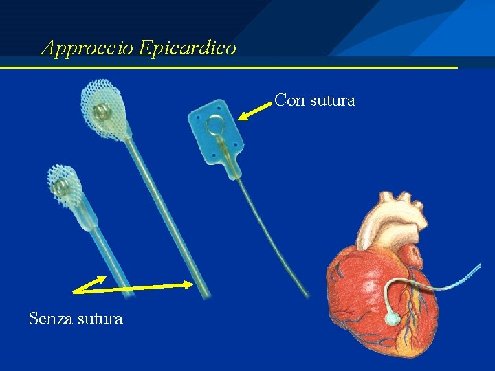 Approccio Epicardico Con sutura Senza sutura 
