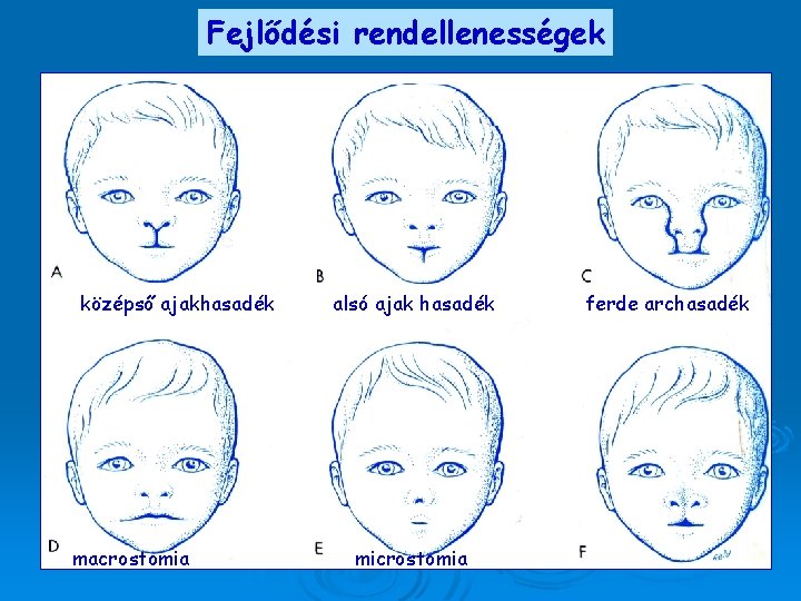 Fejlődési rendellenességek középső ajakhasadék macrostomia alsó ajak hasadék microstomia ferde archasadék 