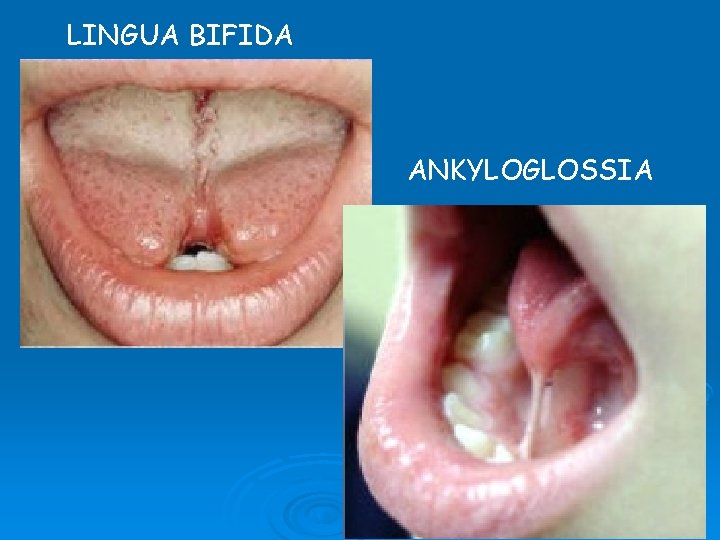 LINGUA BIFIDA ANKYLOGLOSSIA 