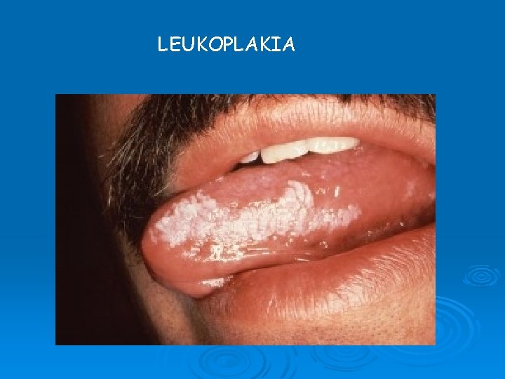 LEUKOPLAKIA LEUKOPLAKIA