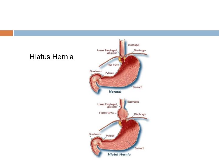 Hiatus Hernia 