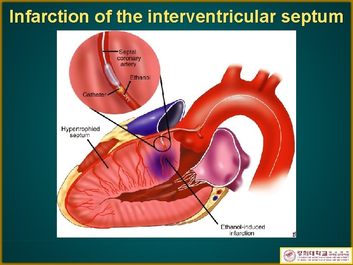 Infarction of the interventricular septum 