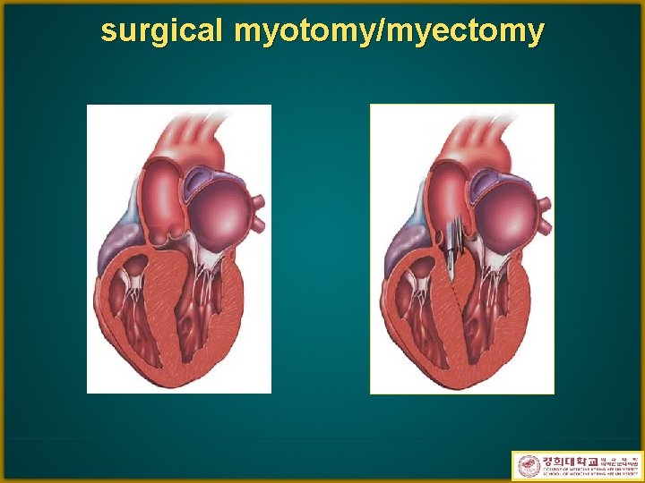 surgical myotomy/myectomy 