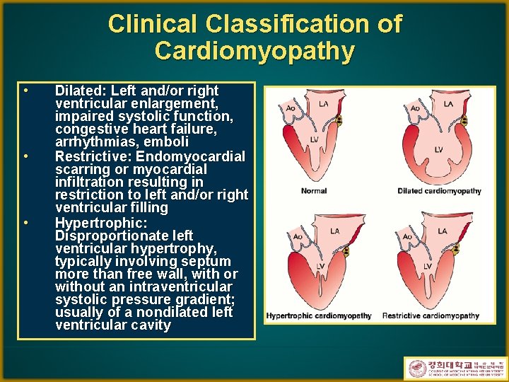 Clinical Classification of Cardiomyopathy • • • Dilated: Left and/or right ventricular enlargement, impaired
