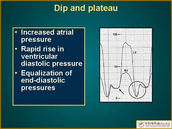 Dip and plateau • Increased atrial • • pressure Rapid rise in ventricular diastolic