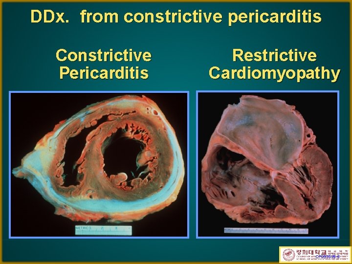 DDx. from constrictive pericarditis Constrictive Pericarditis Restrictive Cardiomyopathy CP 983059 -6 