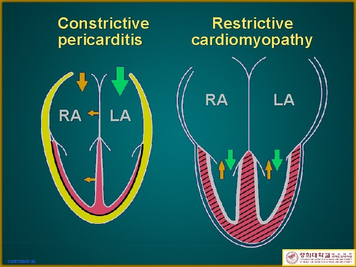 Constrictive pericarditis RA CM 875969 -36 LA Restrictive cardiomyopathy RA LA 