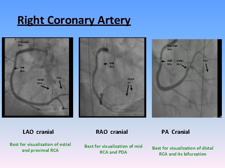 Right Coronary Artery Proximal RCA Mid RCA Distal RCA PDA LAO cranial Best for