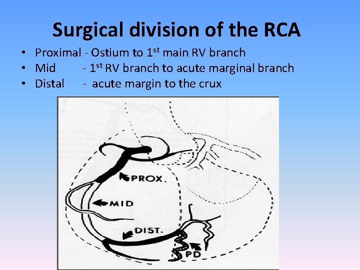 Surgical division of the RCA • Proximal - Ostium to 1 st main RV