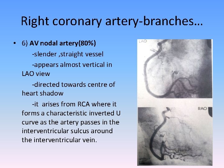 Right coronary artery-branches… • 6) AV nodal artery(80%) -slender , straight vessel -appears almost