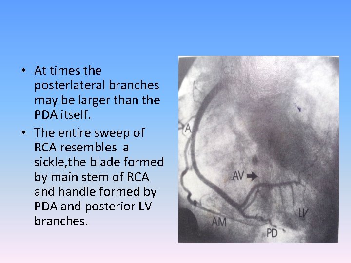  • At times the posterlateral branches may be larger than the PDA itself.