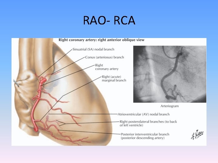 RAO- RCA 