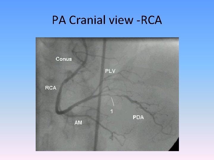 PA Cranial view -RCA 